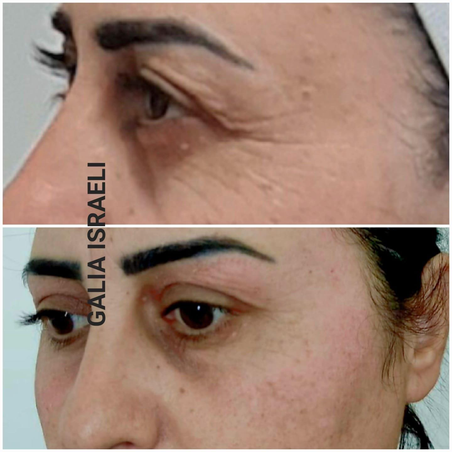 Before and after — Periorbital Tightening